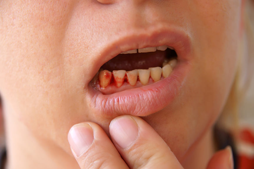 Are Your Gums Bleeding? Don’t Ignore These Warning Signs