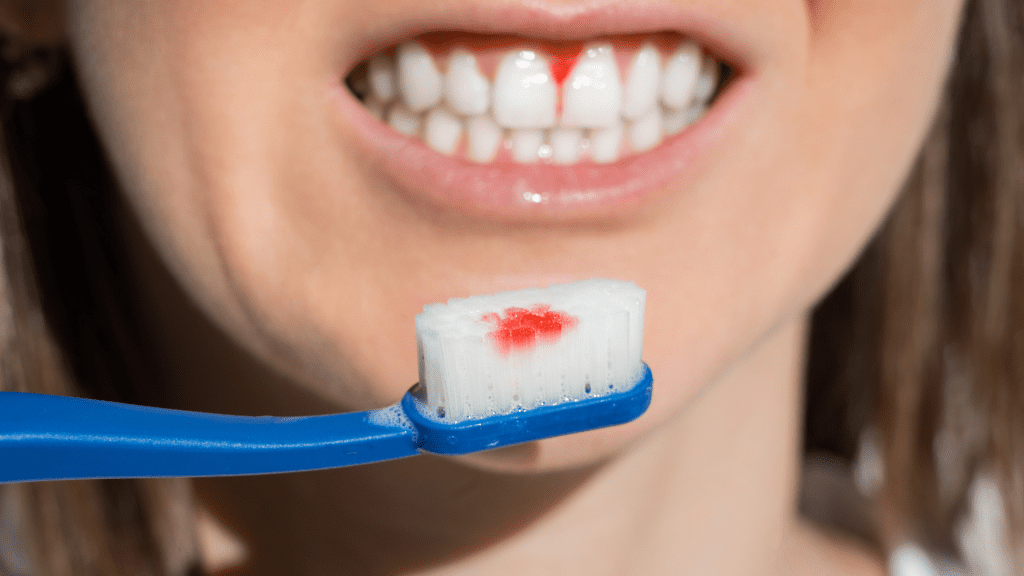 Gum Disease