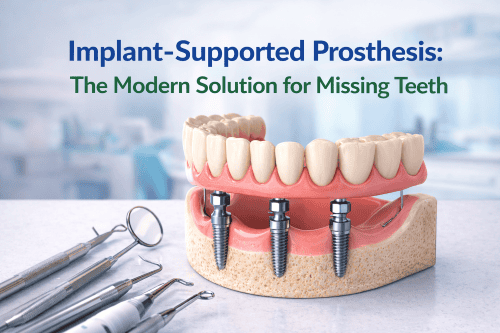 Implant-Supported Prosthesis: The Modern Solution for Missing Teeth 